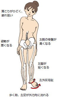 側弯症　灘区