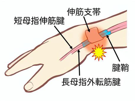 神戸　整体　腱鞘炎