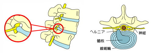 ヘルニア画像　神戸