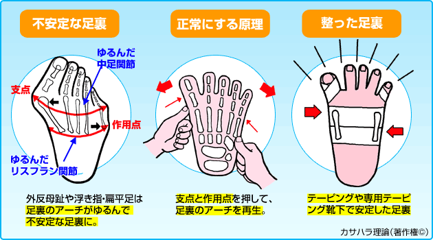 摩耶　外反母趾