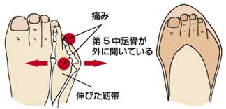 内反小趾　整体　神戸