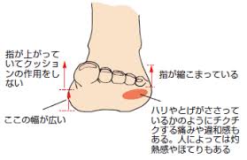 モートン病　整体　神戸