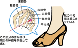 モートン病　王子公園