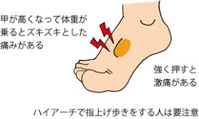 足の甲の痛み　整体　神戸
