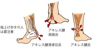 アキレス腱炎の痛み　整体　神戸